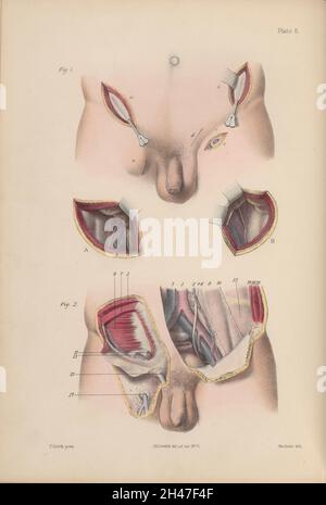 Platte 6, Ligatur der Arteria iliaca und der gemeinsamen Femurarterien. Stockfoto