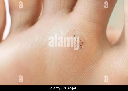 Warze auf einer stumpfen Nahaufnahme. Makroaufnahme des menschlichen Papilloms auf dem Fuß. Stockfoto