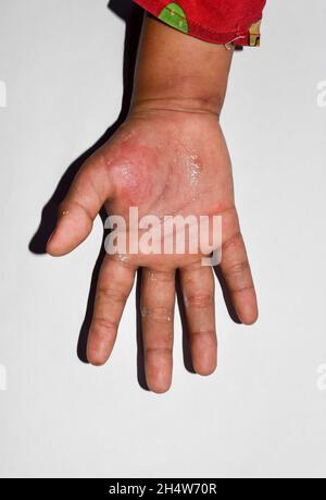 Einseitiges Ödem mit Krätze der oberen Extremität. Geschwollene Hand und Arm des asiatischen Kindes. Stockfoto