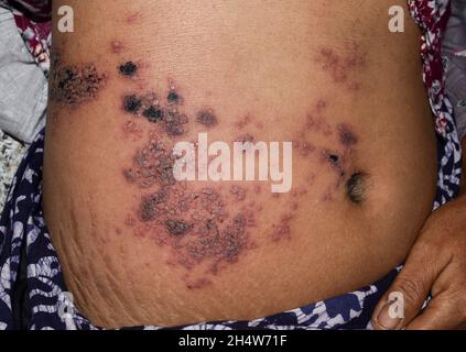 Herpes-Simplex-Infektion am Bauch der asiatischen Frau. Kleine und schmerzhafte Vesikel. Stockfoto