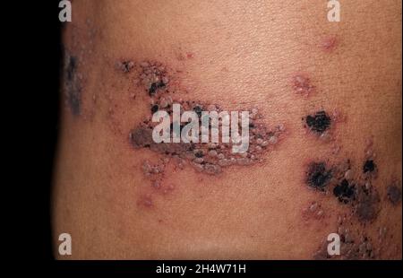 Herpes-Simplex-Infektion am Bauch der asiatischen Frau. Kleine und schmerzhafte Vesikel. Stockfoto