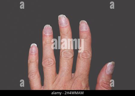 Nahaufnahme von gebissenen und brüchigen Nägeln ohne Maniküre. Überwucherte Nagelhaut-Fingernägel und befleckte Nagelplatte. Nagelhaut überwuchert Nägel und beschädigte Nagel Stockfoto