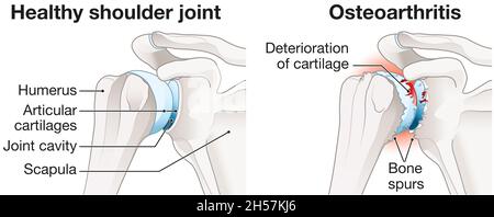 Abbildung zeigt gesundes Schultergelenk und Arthrose des Schultergelenks Stockfoto