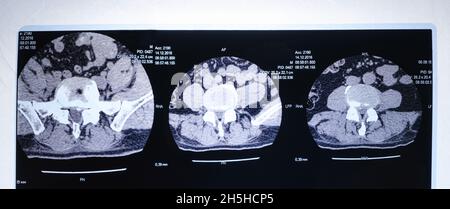 CT-Bild der Wirbelsäule eines Patienten mit Skoliose und Vorwölbung der Bandscheibe. Stockfoto