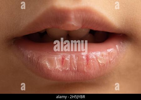 Die rissenden Lippen eines kleinen Mädchens aufgrund von Kälte und Austrocknung Stockfoto