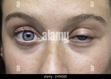 Nahaufnahme der Augen von Mädchen mit Lazy-Eyelid-Syndrom Stockfoto