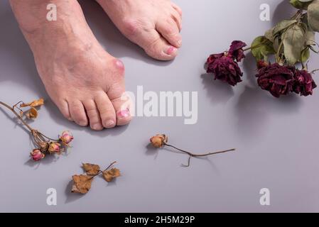 Konzept der Fußkrankheit bei alter Frau mit trockenen Blumen Stockfoto