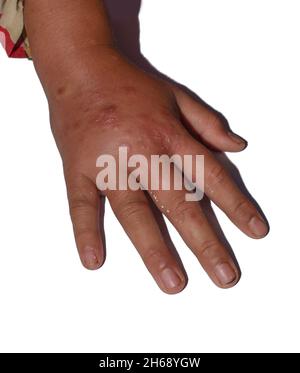 Einseitiges Ödem mit Krätze der oberen Extremität. Geschwollene Hand und Arm des asiatischen Kindes. Stockfoto