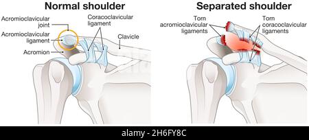 Die Abbildung zeigt die acromioklavikuläre Gelenktrennung oder die AC-Gelenktrennung oder Schultertrennung. Abbildung Stockfoto