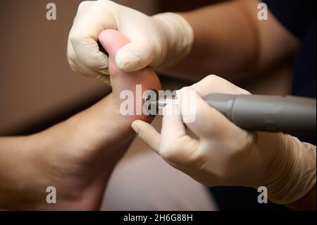 Nahaufnahme eines Fußschälvorgangs von Schwielen an den Füßen durch die podiatrischen Hände in weißen medizinischen Schutzhandschuhen in einem Schönheitssalon Stockfoto