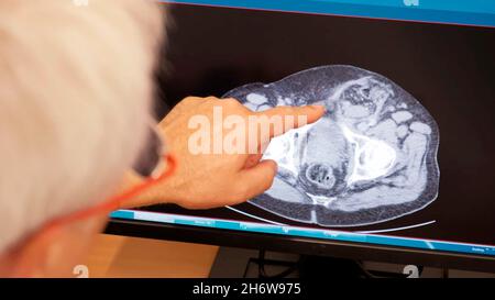 Nahaufnahme der Hand eines Arztes oder Chirurgen, die zur Analyse auf eine Röntgenaufnahme des Gehirns auf einem Monitor zeigt. Stockfoto