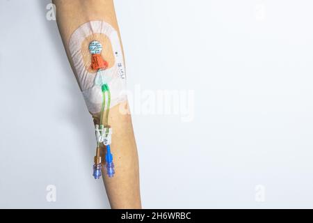 DIE PICC-Linie (peripher eingeführte zentrale Katheterlinie) wird in den Arm eingeführt, um eine Chemotherapie oder andere Medikamente zu verabreichen Stockfoto