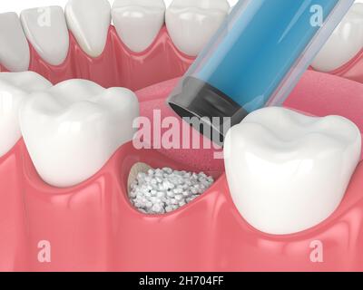 3D Rendering der dentalen Knochentransplantation mit dentaler Knochenbiomaterialapplikation. Knochenaufbaukonzept. Stockfoto