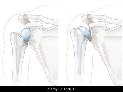 Abbildung zeigt die umgekehrte Schulterartroplastik und die totale Schulterartroplastik Stockfoto