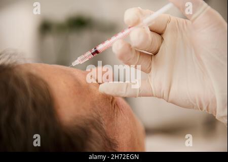 Weicher Fokus auf einer Spritze mit Beauty-Produkt auf den Händen des Ästhetikers in weißen OP-Handschuhen, die Injektion auf das Gesicht des Mannes mittleren Alters für Rej Stockfoto