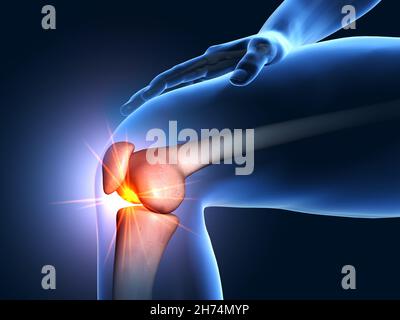 3D Abbildung mit schmerzhaftem Kniegelenk, medizinisch 3D Abbildung Stockfoto