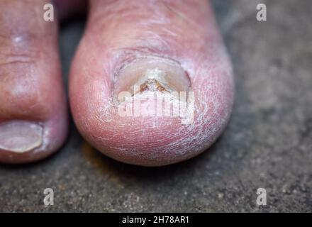 Beschädigter und rissiger Zehennagel. Pilznagelinfektion. Onychomykose, auch Tinea unguium genannt. Stockfoto