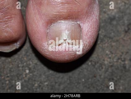 Beschädigter und rissiger Zehennagel. Pilznagelinfektion. Onychomykose, auch Tinea unguium genannt. Stockfoto