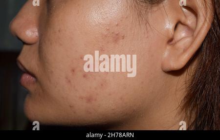 Akne, schwarze Flecken und Narben auf dem Gesicht der asiatischen jungen Frau. Stockfoto