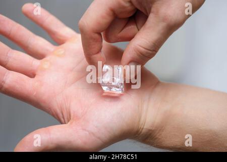 Ein Stück Eis auf der Handfläche eines Mannes, Schwielen auf seinen Händen Stockfoto