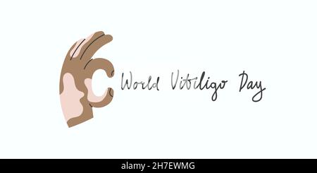 Hand mit Vitiligo macht ok Geste. Karte der Welt Vitiligo Tag. Stock Vektor