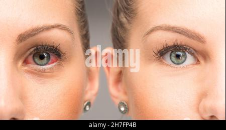 Weibliches Halbgesicht vor und nach der roten Augenpflege, Allergie und Konjunktivitis Rötung Konzept Stockfoto