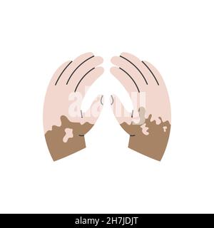 Hände mit einem großen Altersfleck. Palm-Symbol mit Vitiligo Stock Vektor