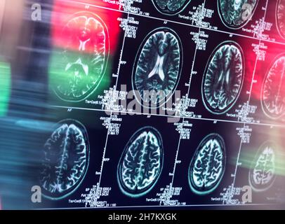Untersuchung des menschlichen Gehirns in einer neurologischen Klinik Stockfoto