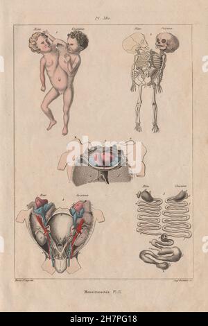 Siamesische Zwillinge: 'Monstruosités' II. Siamesische Zwillinge, antiken Drucken 1833 Stockfoto
