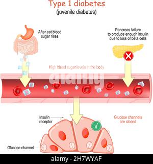 Typ-1-Diabetes. Jugenddiabetes. Hoher Blutzuckerspiegel im Körper. Die Glukosekanäle in den Zellen sind geschlossen. Vektor-Poster für Bildungs-und m Stock Vektor