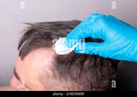 Behandlung von menschlichem Haarausfall nach Coronavirus. Ein Arzt in blauen medizinischen Handschuhen untersucht das Haar und die Kopfhaut eines Mannes, wischt es mit einem Wattepad, clos Stockfoto