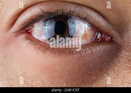 Nahaufnahme eines roten, durch Konjunktivitis und Augenlid-Herpes geplappten menschlichen Auges Stockfoto