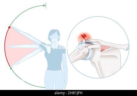 Abbildung zeigt das Schulter-Impingement-Syndrom und den schmerzhaften Lichtbogen Stockfoto