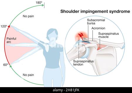 Abbildung zeigt das Schulter-Impingement-Syndrom und den schmerzhaften Lichtbogen Stockfoto