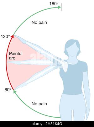 Abbildung zeigt das Schulter-Impingement-Syndrom und den schmerzhaften Lichtbogen Stockfoto