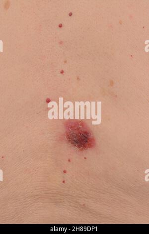 Basalzell-Karzinom Stockfoto