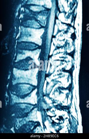 Osteoporose an Lendenwirbeln Stockfoto