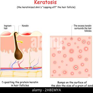 Keratose. Hauterkrankung. Draufsicht mit Ablagerung des Proteins Keratin in Haarfollikeln. Und Querschnitt der menschlichen Haut mit Beulen auf der Oberfläche der Stock Vektor