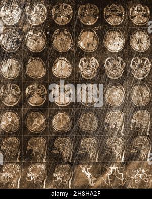 CT-Scan des menschlichen Kopfes auf dem veralteten rostigen metallischen Hintergrund. Stockfoto