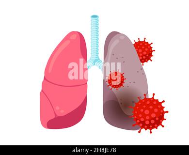 Gesunde und kranke, ungesunde Lungen mit einer Coronavirus-Infektionskrankheit. Inneres Organ des menschlichen Atmungssystems mit Lungenentzündung. Abbildung des Vektors eps für infizierte COVID-19-Lungenerkrankungen. Pandemieschäden Stock Vektor