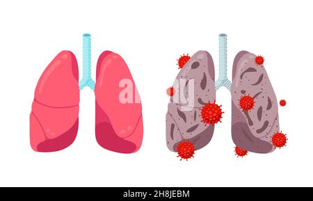 Gesunder Impfschutz und ungesunde Lungen mit Coronavirus-Infektionskrankheit. Internes Organ des menschlichen Atmungssystems mit Corona-Virus-Pneumonie. Infizierte COVID-19 Lungenerkrankung eps Illustration Stock Vektor