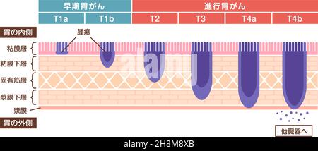 Stadien von Magenkrebs (Magenkrebs) . Vektorgrafik Stock Vektor