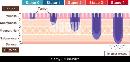 Stadien von Magenkrebs (Magenkrebs) . Vektorgrafik Stock Vektor