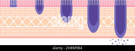 Stadien von Magenkrebs (Magenkrebs) . Vektorgrafik Stock Vektor