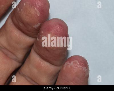 Detail der Peelings nach Scharlach bei einem erwachsenen Kaukasusmenschen Stockfoto