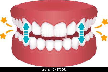 Bruxismus Vektor Illustration | Klopfzähne Stock Vektor