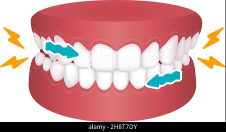 Bruxismus Vektorgrafik | Zähneknirschen Stock Vektor
