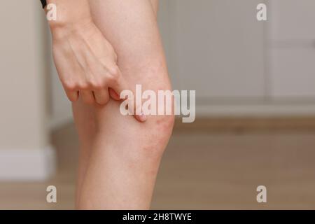 Hautallergien, Beine Haut Frauen. Nahaufnahme von roten Pusteln am Knie, einer allergischen Reaktion, die durch atopische Dermatitis verursacht wird. Ausgewählter Fokus. Stockfoto