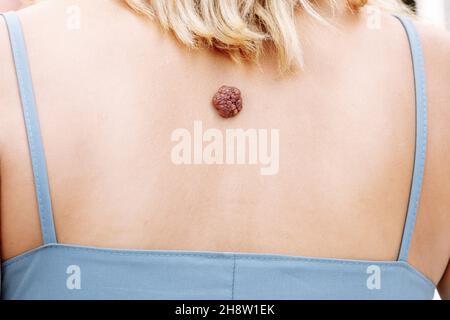 Warze. Maulwurf. Große Warze auf der Haut. Hautkrankheiten bösartiger Tumor. Dermatologie. Onkologie Stockfoto