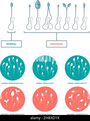 Spermogramm. Medizinische Infografik mit gesunden und beschädigten Spermatozoen Geburtsplan Eisprung Prozesse grellen Vektor-flache Vorlagen Stock Vektor